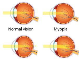 Bayfields Eye Care Myopia Diagram (1)